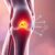 Hyalofast w rehabilitacji stawów – nowoczesne metody regeneracji